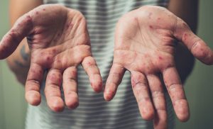У Гродне зафіксаваны першы ў гэтым годзе выпадак грыпу У Гродне зафіксаваны першы ў гэтым годзе выпадак грыпу